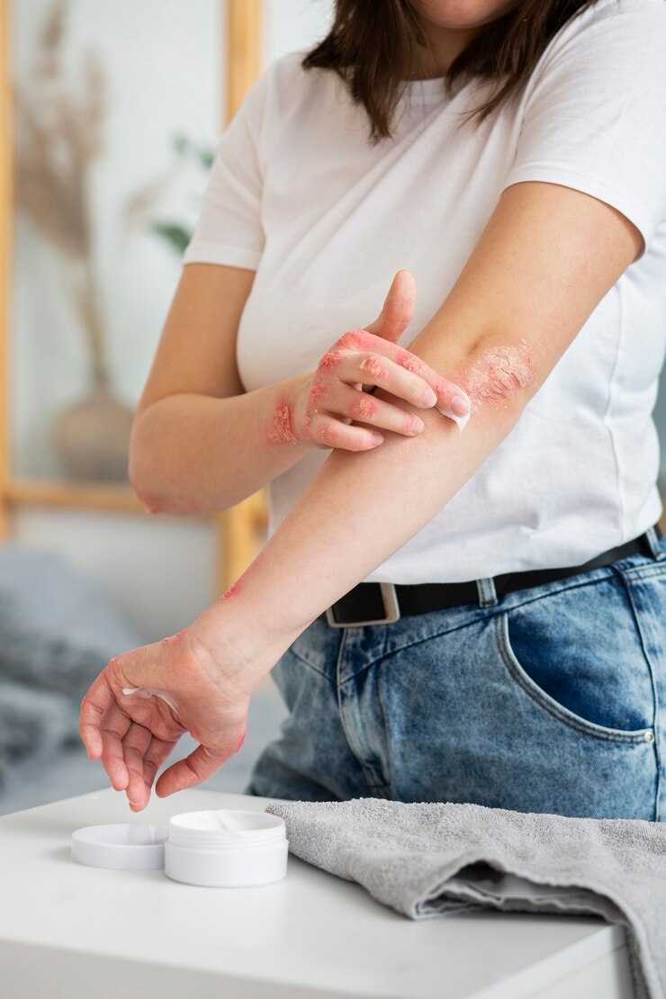 Homemade Herbal Cream for Eczema Relief
