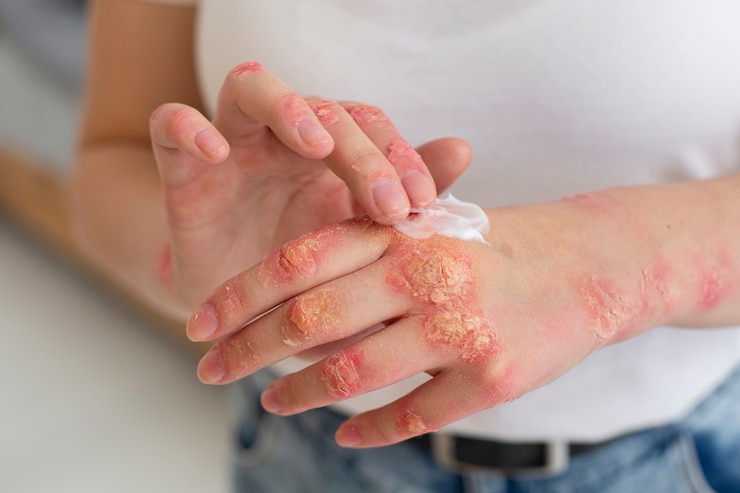 7 Essential Tips for Naturally Eliminating Eczema